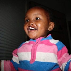Before of little girl with cleft palate