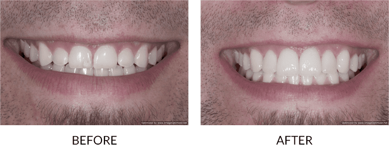Veneers Porcelain San Diego La Jolla Cosmetic Dentistry Orthodontics