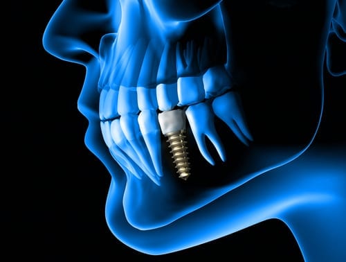 X ray view of denture with implant
