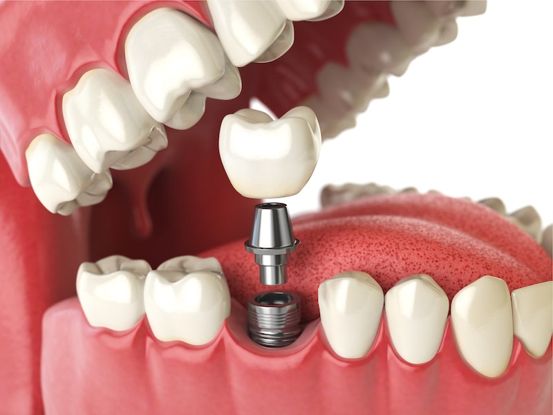 Illustration of a dental implant.