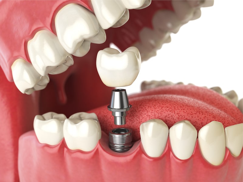 Want a Tooth Restoration Option That Will Outlast Quarantine? Consider Dental Implants