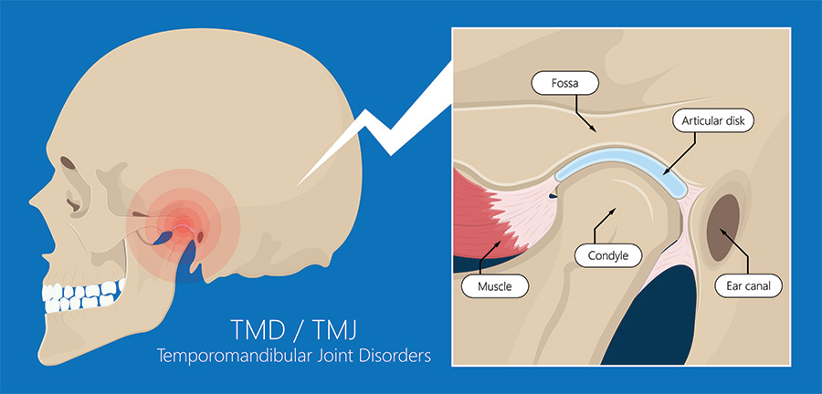TMJ Treatment Diagram