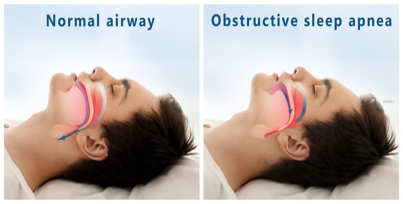 Two images of a man sleeping and illustrations of a normal airway and one in obstructive sleep apnea.