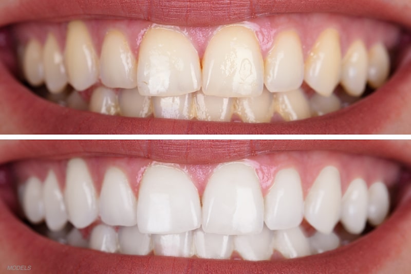 Before and after teeth whitening.