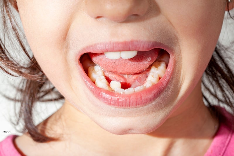 Does Your Child Need Interceptive Orthodontic Treatment?