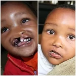 before and after photo of child patient