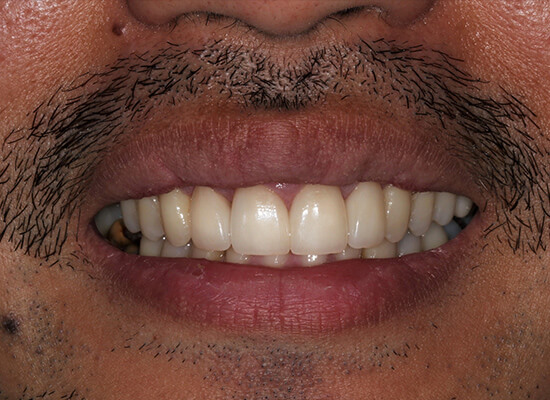 Case--2494 | After Smile Makeover