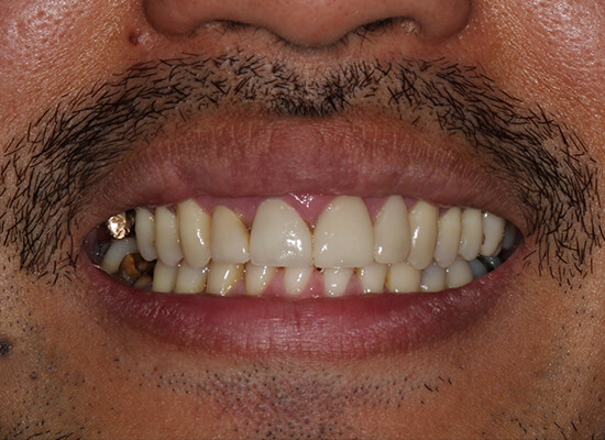 Case--2494 | Before Smile Makeover