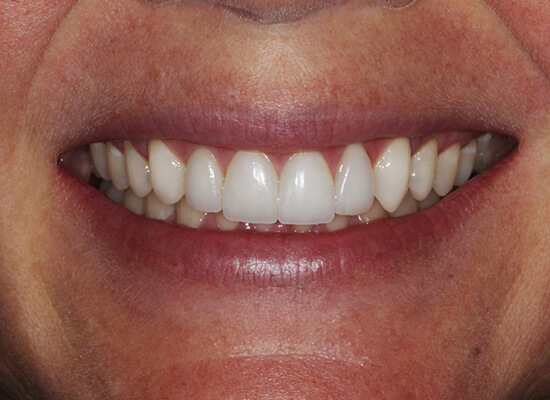 Case--5930 | After Smile Makeover