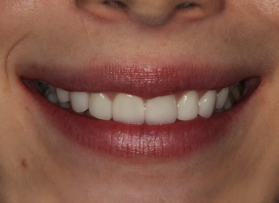 Case--9452 | After Smile Makeover