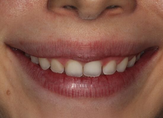 Case--9452 | Before Smile Makeover