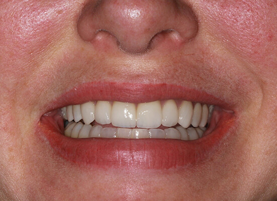 Case--6166 | After Smile Makeover