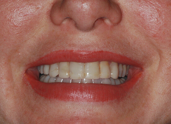 Case--6166 | Before Smile Makeover