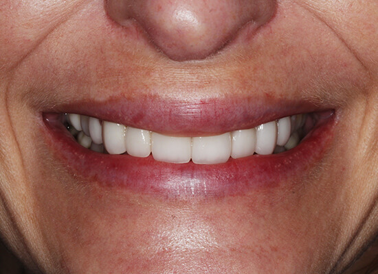 Case--1630 | After Smile Makeover