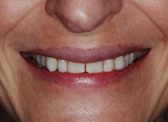 Case--1630 | Before Smile Makeover