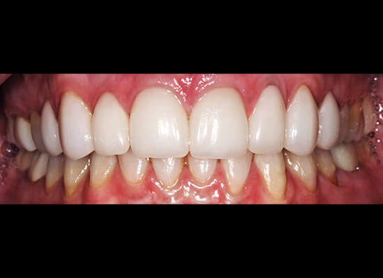 Case--1630 | After Smile Makeover 2