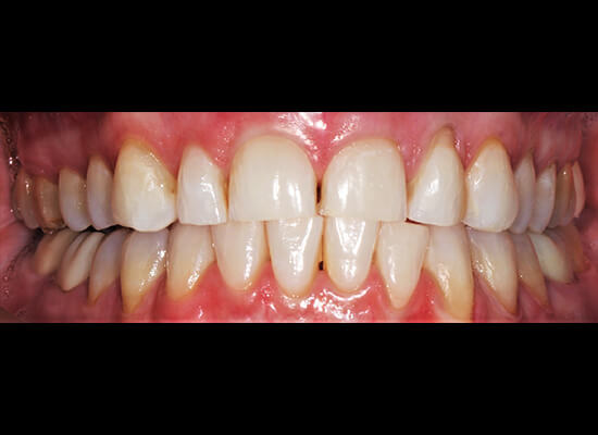 Case--1630 | Before Smile Makeover 2