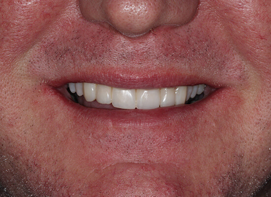 Case--7828 | After Smile Makeover