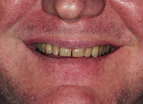 Case--7828 | Before Smile Makeover