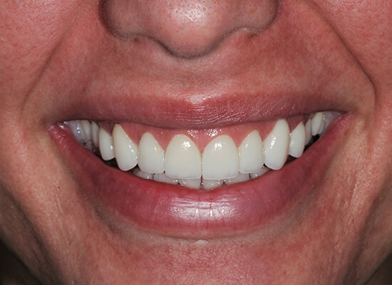 Case--2248 | After Smile Makeover