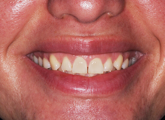 Case--2248 | Before Smile Makeover