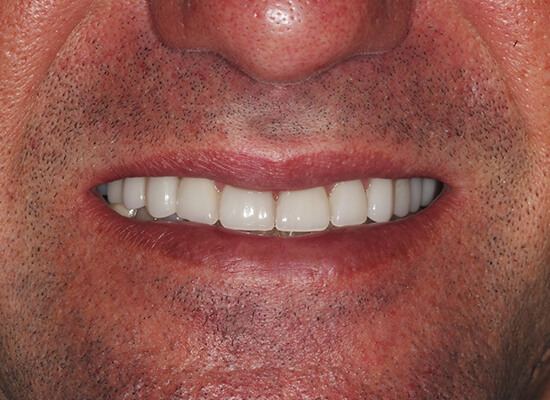 Case--6764 | After Smile Makeover