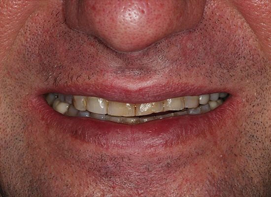 Case--6764 | Before Smile Makeover