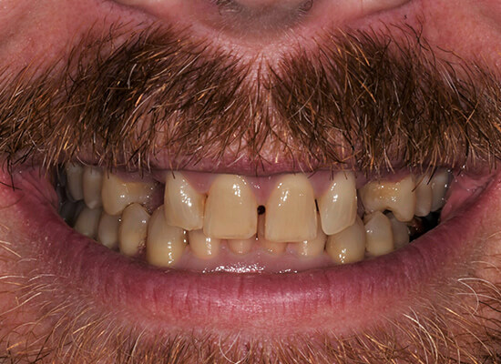 Case--8674 | Before Smile Makeover