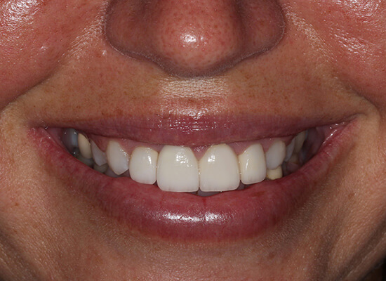 Case--8283 | After Smile Makeover