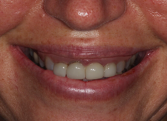 Case--8283 | Before Smile Makeover