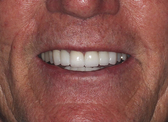 Case--4500 | After Smile Makeover