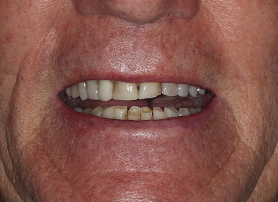 Case--4500 | Before Smile Makeover